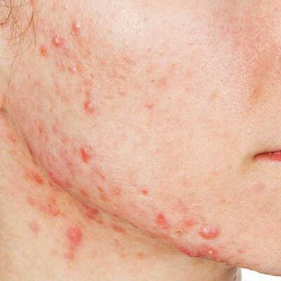 La Roche-Posay Effaclar H Iso-Bıome Creme 40 ml - 2